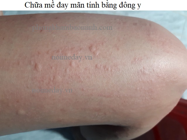 Chữa mề đay mãn tính bằng đông y